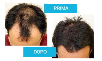 Trasformazione dei capelli dopo Profolan