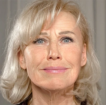 Donna prima del trattamento Retilift: rughe e segni d'età