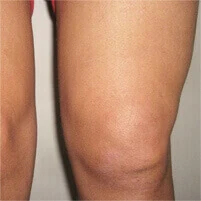 Immagine rappresentativa della sinovite.